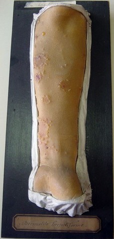 Dermatite herpétiforme de Dühring