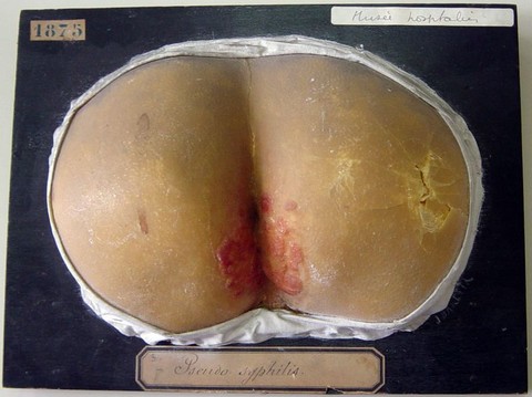 Dermite papuleuse syphiloïde (pseudo-syphilis), de la région périanale